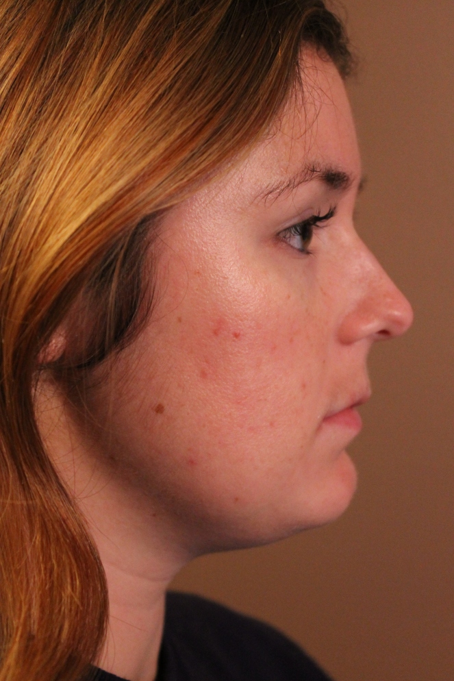 nodular acne